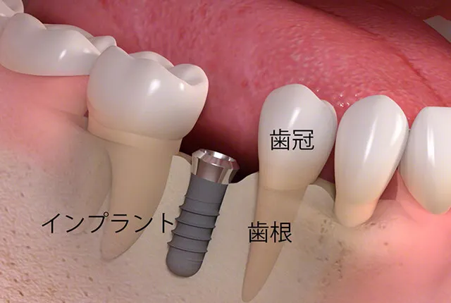 インプラントとは