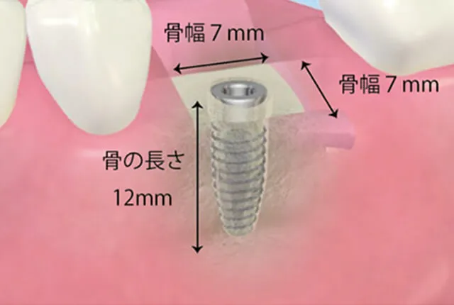 骨が豊富とは？当院の基準について