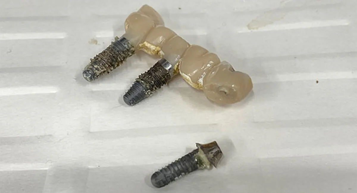 インプラント治療でよくある失敗例