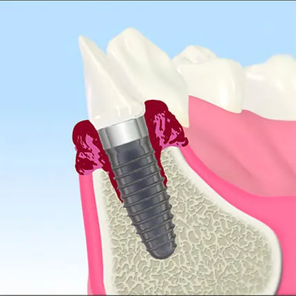 インプラント周囲炎
