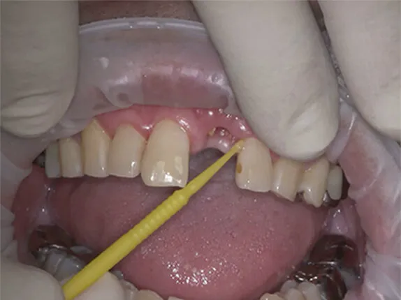 STEP3:接着剤の塗布