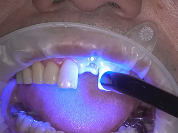 STEP5:ファイバーリボンの固定