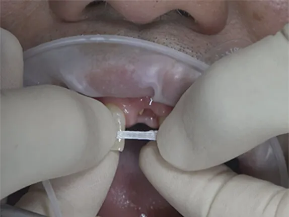 STEP6:レジンの積層