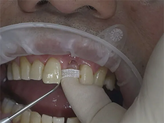 STEP7:形態修正と研磨