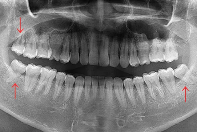 下顎の横向き親知らず