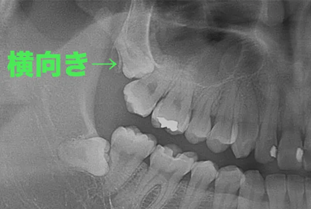 上顎の横向き親知らず