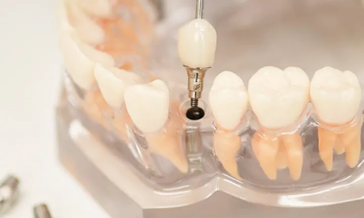 「メインテナンス性の高い」 
            スクリューリテイン