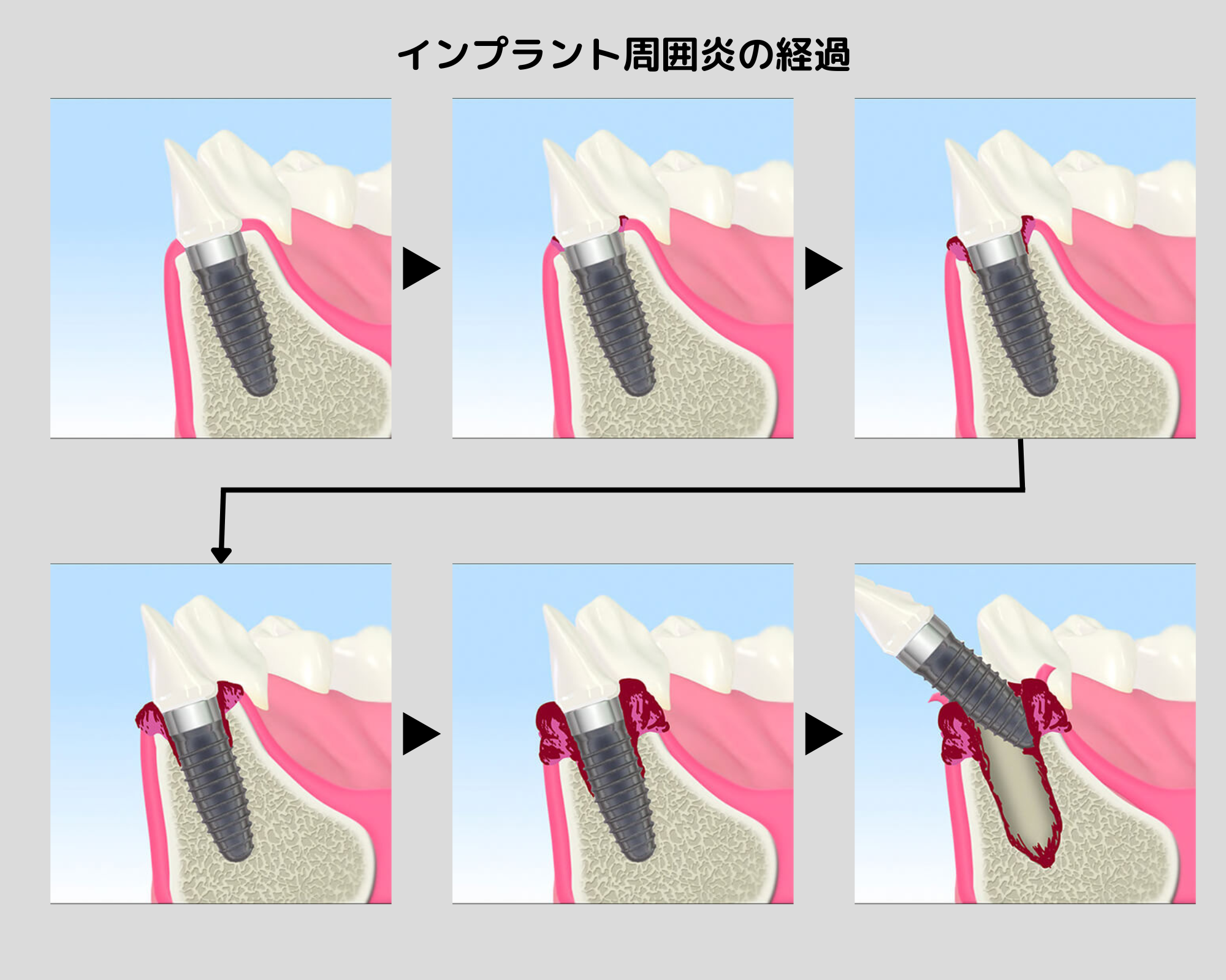 歯周病菌とインプラント周囲炎について | 医療法人社団横浜歯友会 戸塚