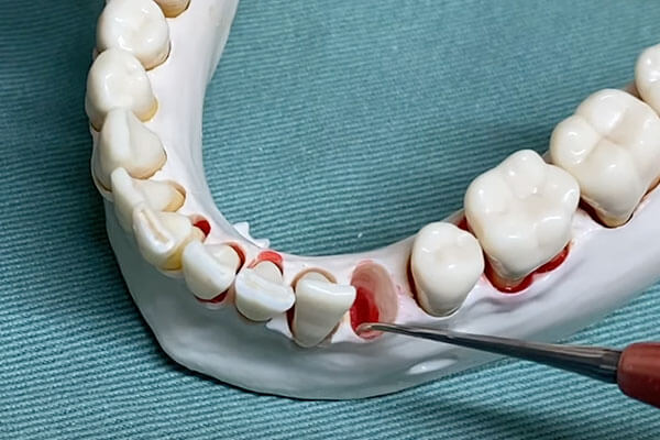 抜歯即時インプラント症例1