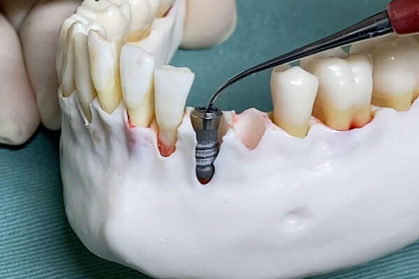 抜歯即時インプラント症例2