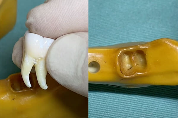 歯の模型1