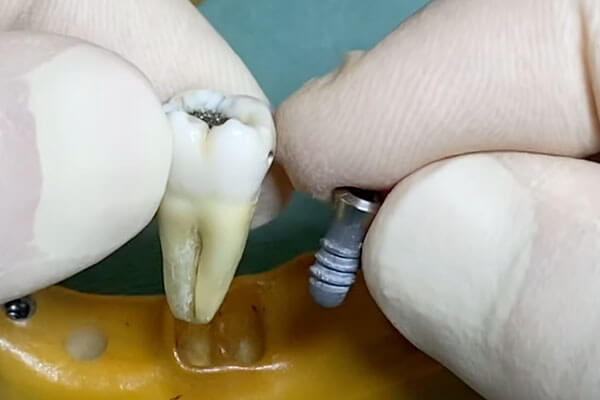 インプラント 歯の模型