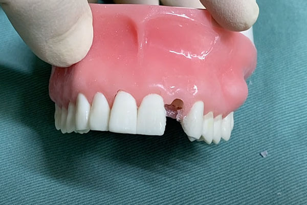 前歯 模型