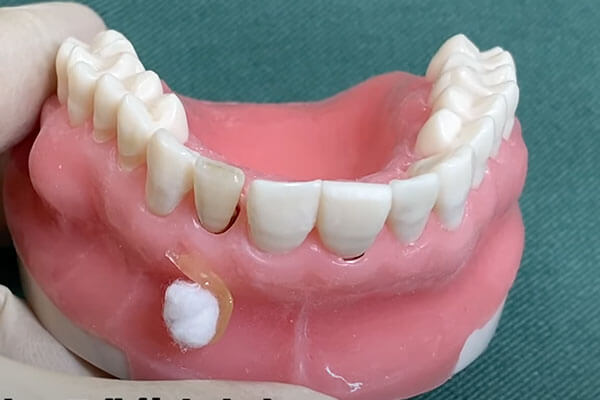 抜歯即時インプラントの術式1