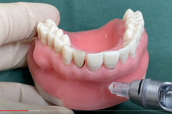 抜歯即時インプラントの術式2