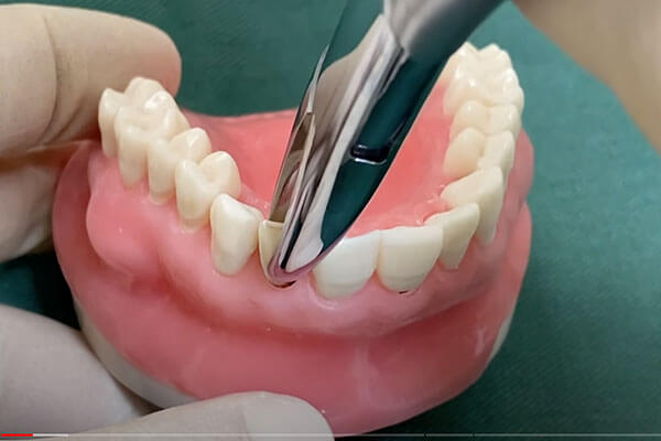 抜歯即時インプラントの術式3