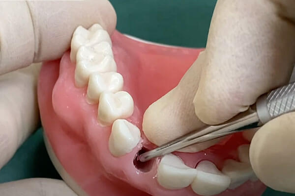 抜歯即時インプラントの術式4