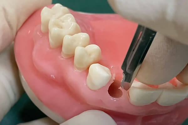 抜歯即時インプラントの術式6