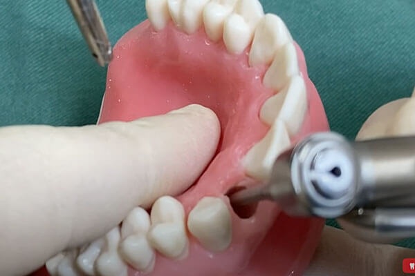 抜歯即時インプラントの術式8