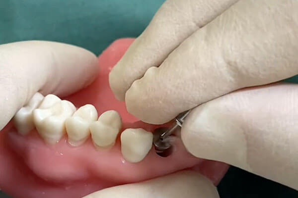 抜歯即時インプラントの術式11