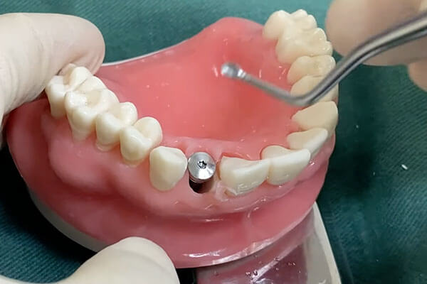 抜歯即時インプラントの術式12