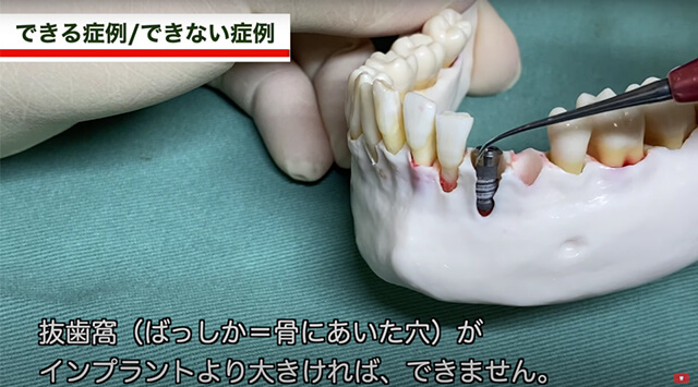 抜歯窩1