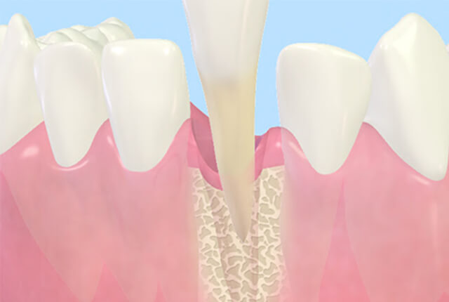 抜歯即時インプラント手術1