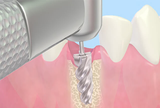 抜歯即時インプラント手術3