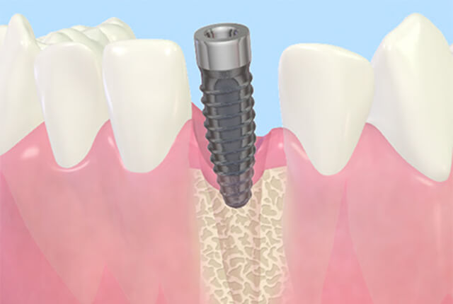 抜歯即時インプラント手術4