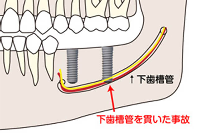 下歯槽神経の損傷