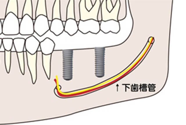 下歯槽管