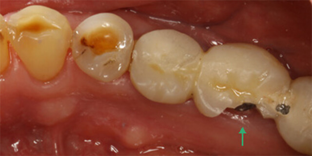 メタルボンド人工歯の破損1