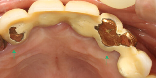 メタルボンド人工歯の破損2