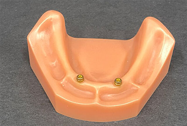 ロケーター義歯の手順4