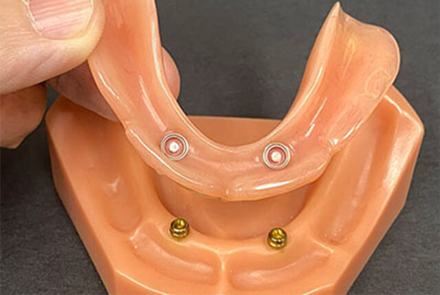 ロケーター義歯の手順5