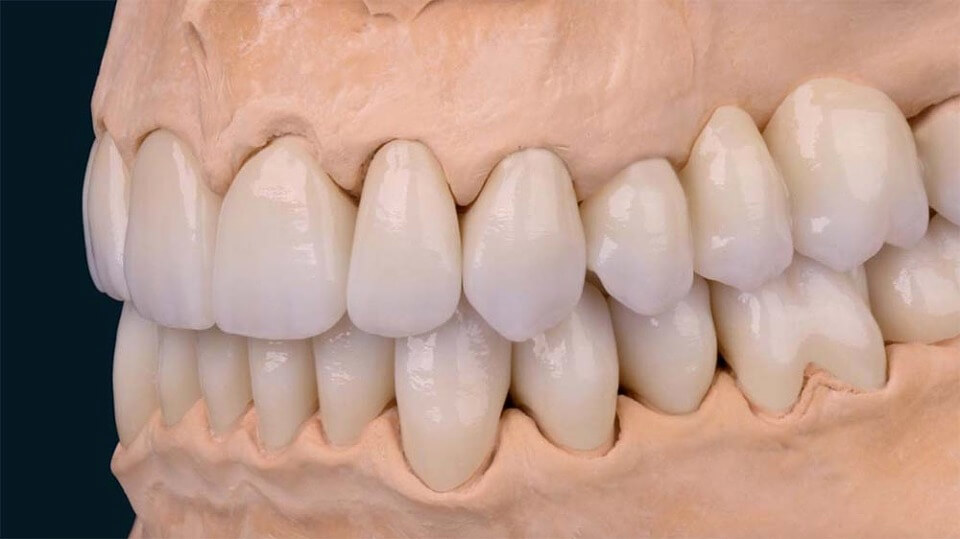人工歯はジルコニア製