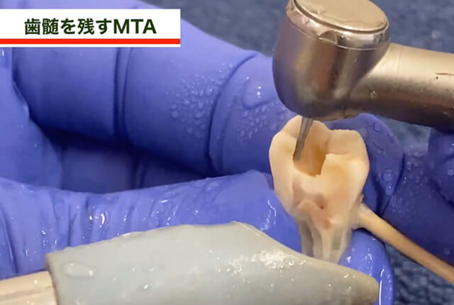 歯髄を残すMTA2