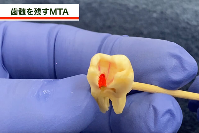 歯髄を残すMTA3