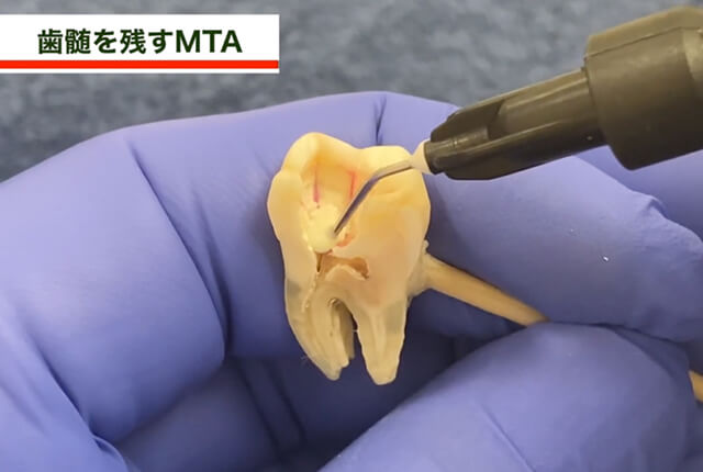 歯髄を残すMTA4