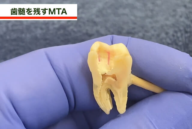 歯髄を残すMTA6