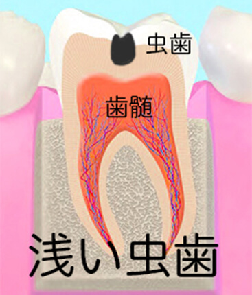 浅い虫歯
