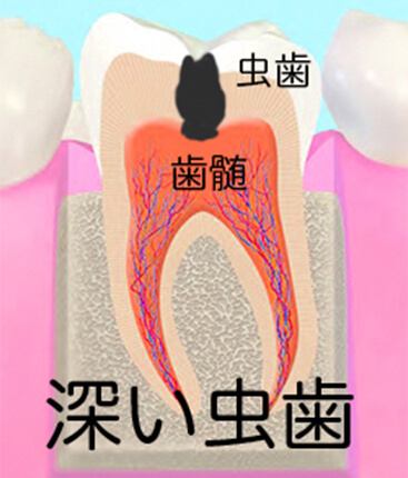 深い虫歯