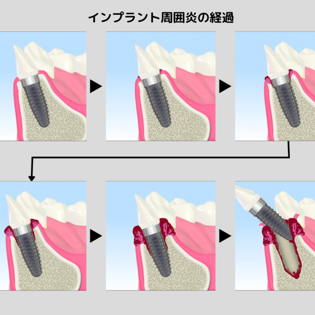 インプラント周囲炎の経過