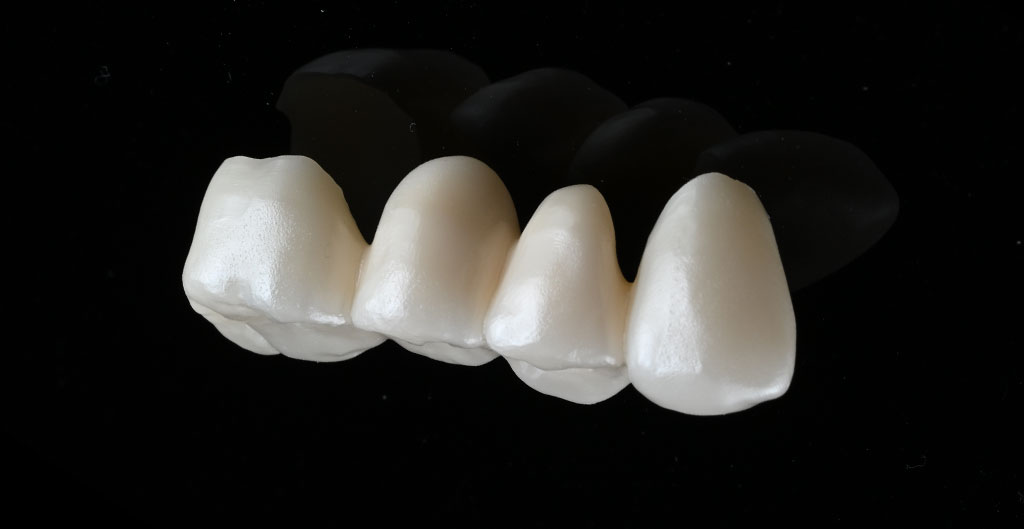 セットしたジルコニアクラウン