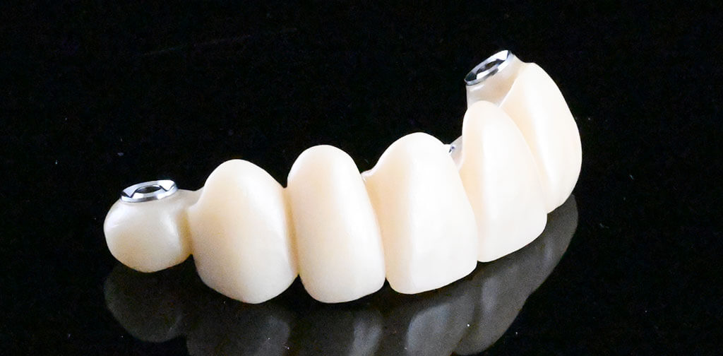 インプラントの種類とそれぞれの特徴