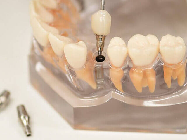 【横浜市】インプラント治療の費用相場と自由診療について解説