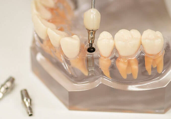 インプラント治療が高額な理由とは？