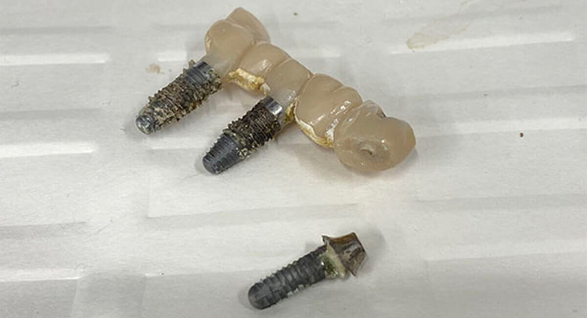 インプラント治療で起こり得るトラブル