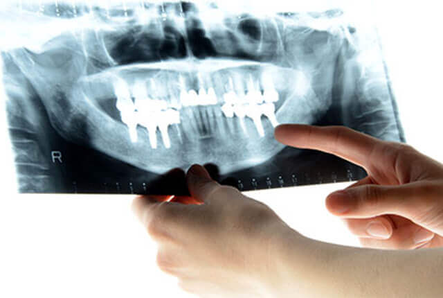 前歯の見た目や安定性に関わる骨と歯ぐきの状態