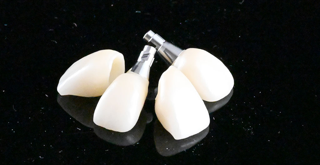 【横浜市】インプラント費用に影響する主な要素